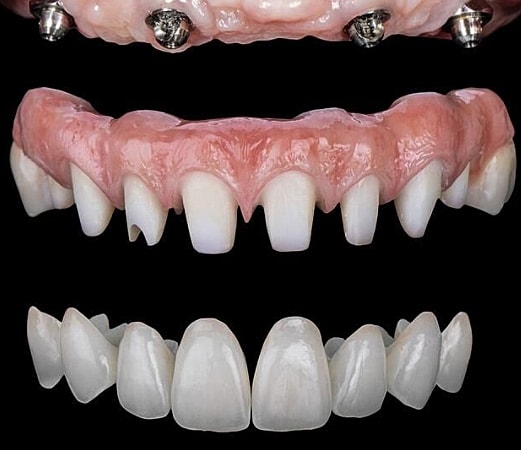 Dental prosthetics: implants and custom dentures displayed.