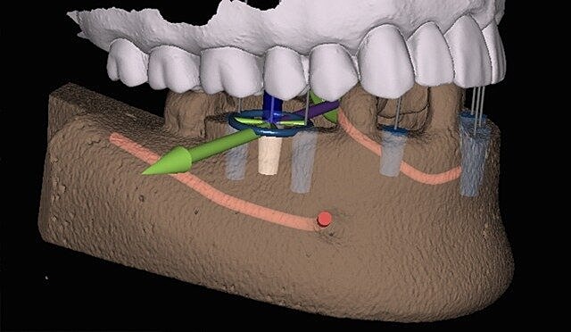 3D model of dental implant setup.