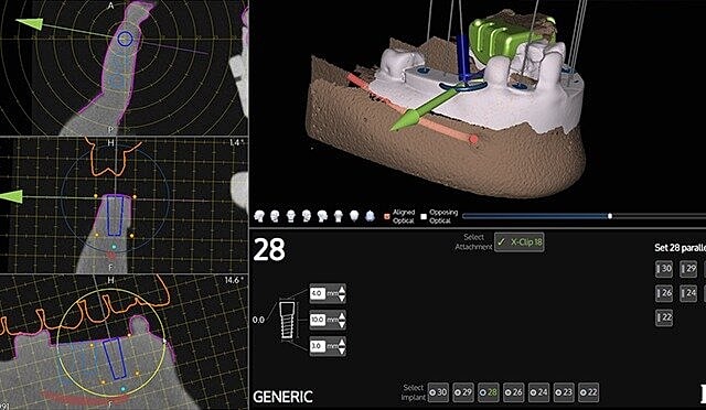 Dental implant planning and visualization software interface.