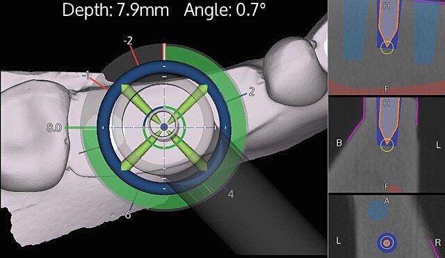 Dental implant placement guidance visualization.