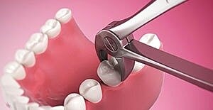 Dental extraction tool removing a tooth.