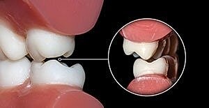 Close-up of teeth alignment and structure.