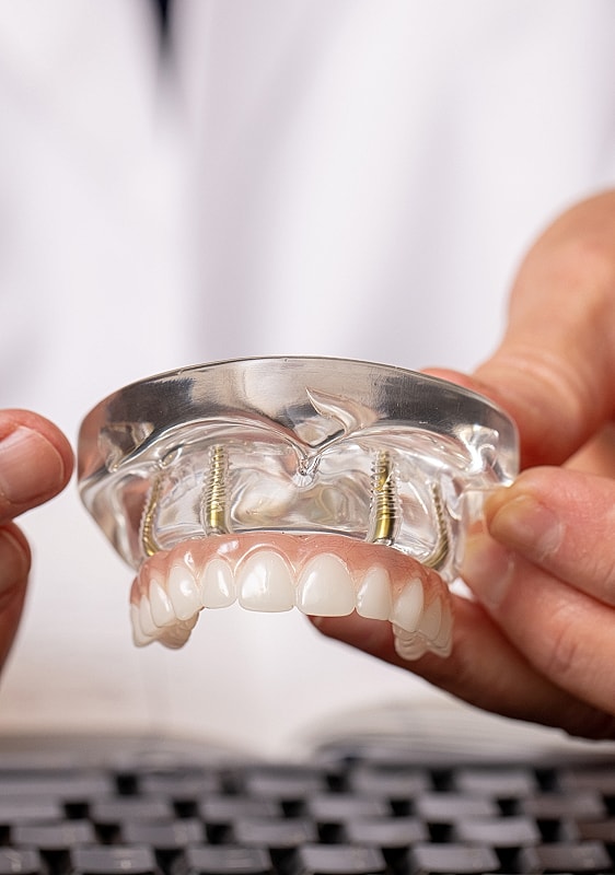 Dental model demonstrating dental implants and teeth.
