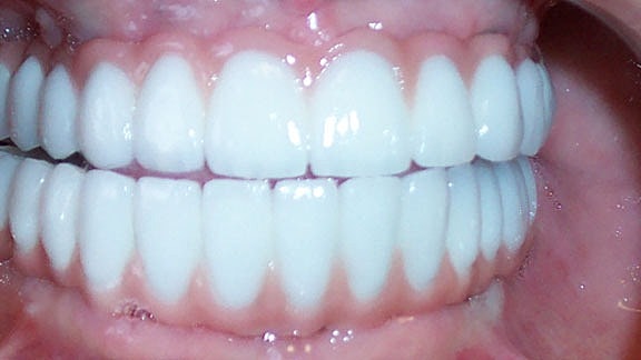 Dental Implants Before & After