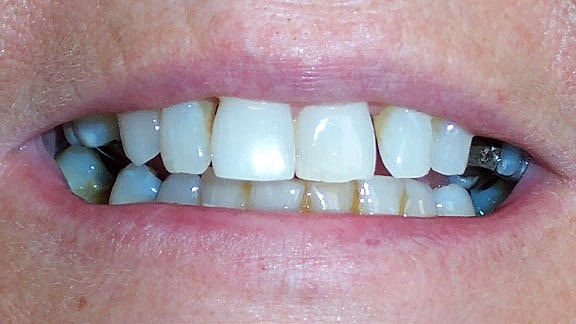 Dental Implants Before & After