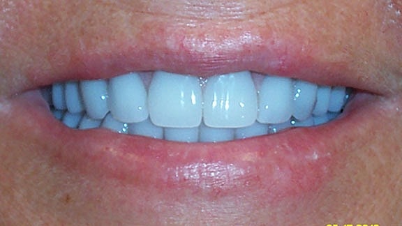 Dental Implants Before & After