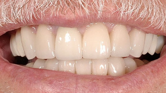 Dental Implants Before & After