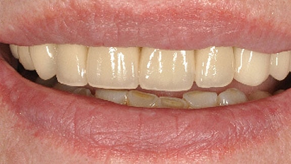 Dental Implants Before & After
