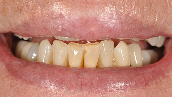 Dental Implants Before & After