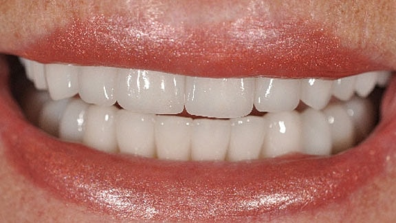 Dental Implants Before & After