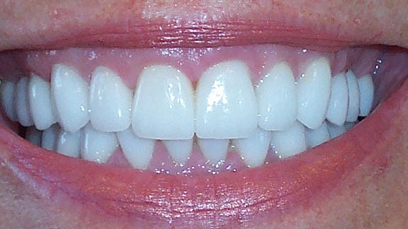 Dental Implants Before & After