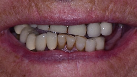 Dental Implants Before & After