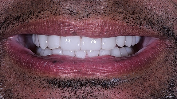 Dental Implants Before & After