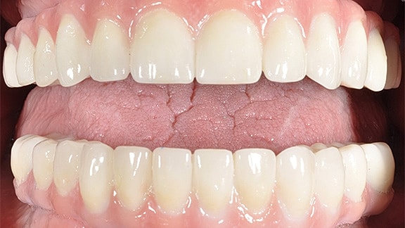 All On 4 Before & After