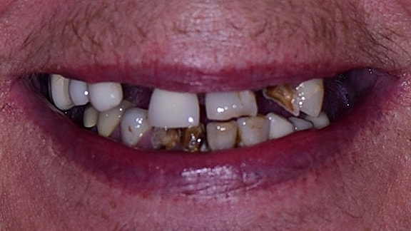 All On 4 Before & After