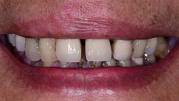 All On 4 Before & After