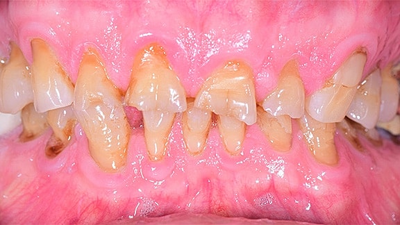 All On 4 Before & After