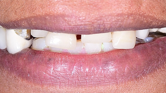 All On 4 Before & After