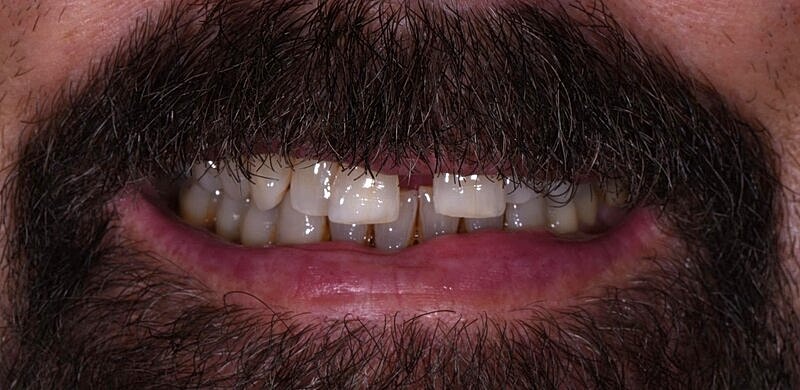 All On 4 Before & After