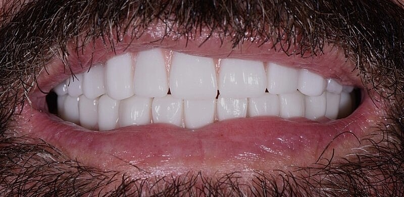 All On 4 Before & After