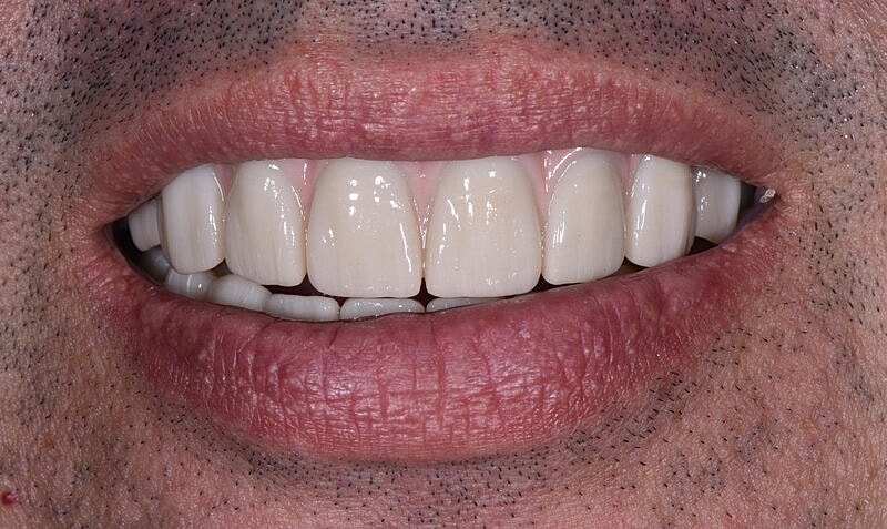 All On 4 Before & After