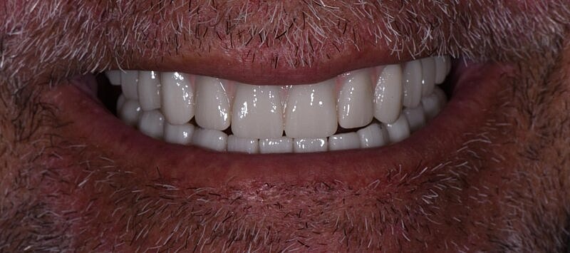 All On 4 Before & After