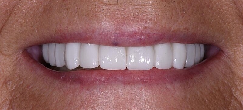 All On 4 Before & After