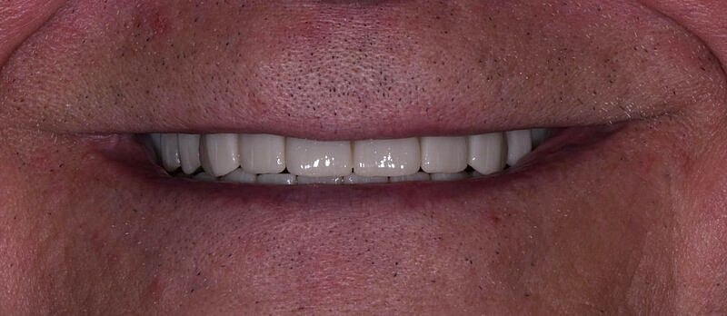 All On 4 Before & After