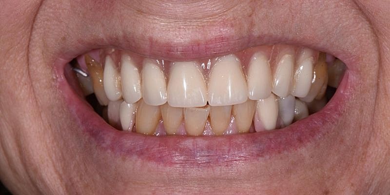 All On 4 Before & After