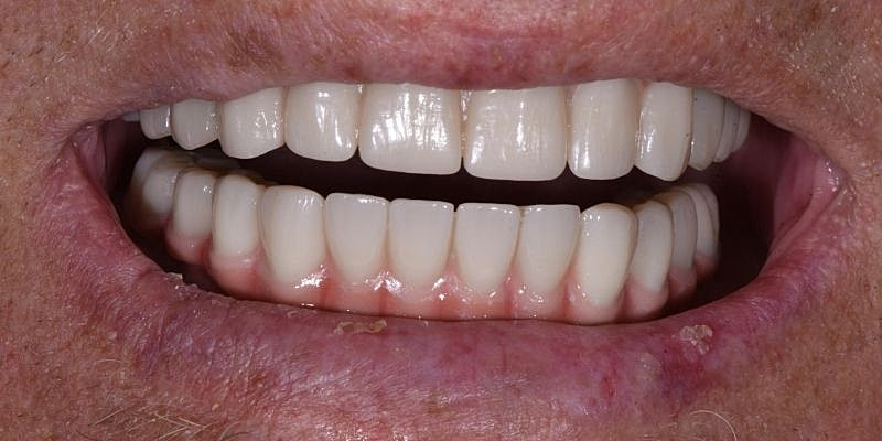 All On 4 Before & After