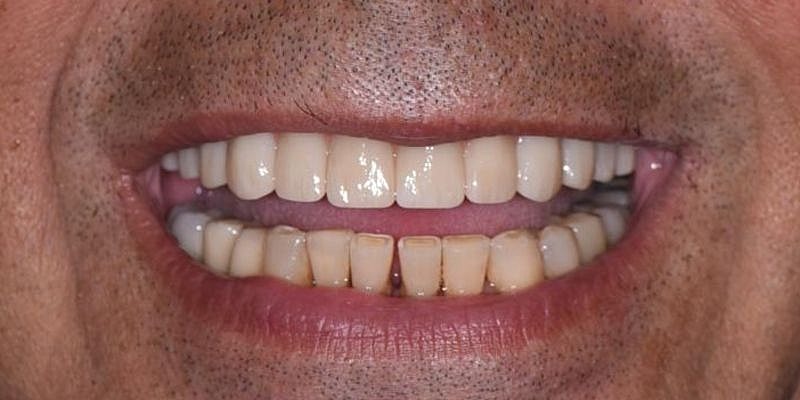 All On 4 Before & After
