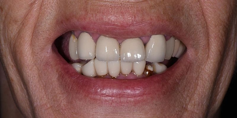 All On 4 Before & After