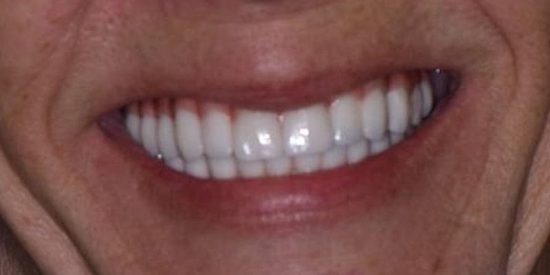 All On 4 Before & After