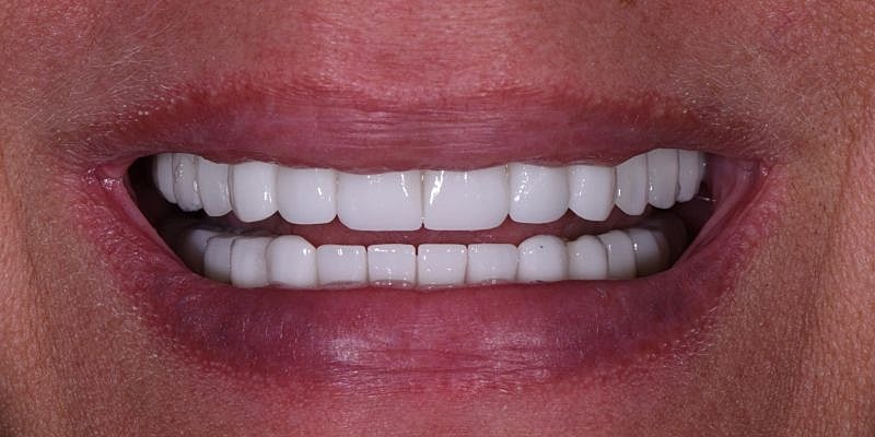 All On 4 Before & After