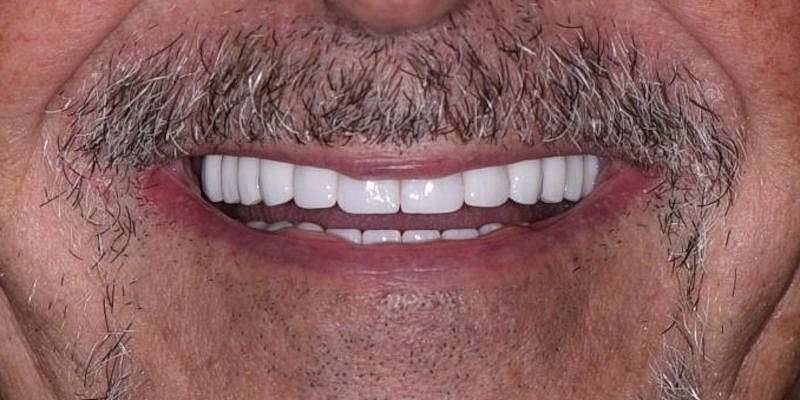 All On 4 Before & After