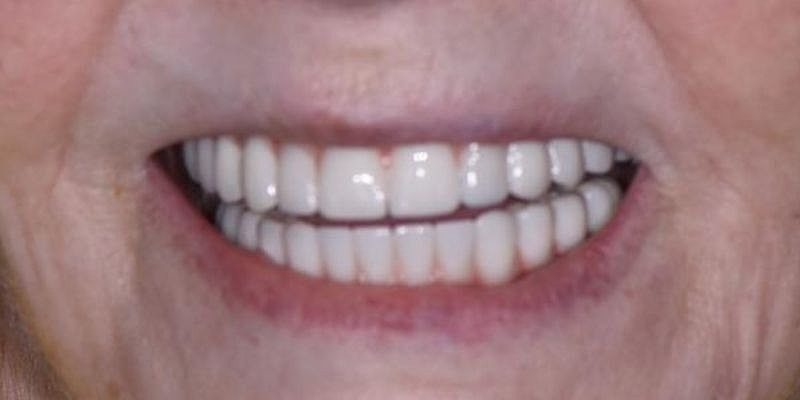 All On 4 Before & After