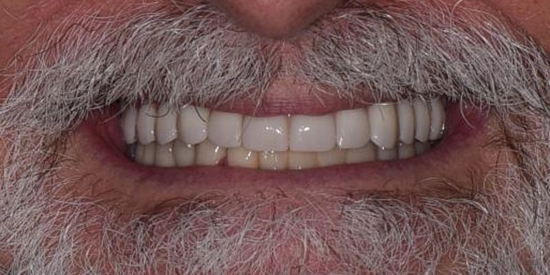 All On 4 Before & After
