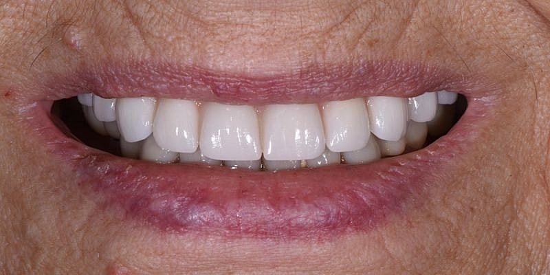All On 4 Before & After