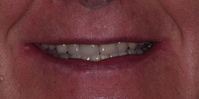 All On 4 Before & After