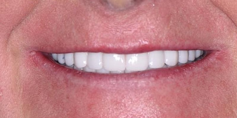 All On 4 Before & After