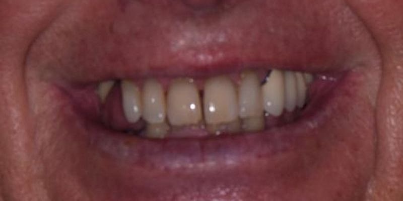 All On 4 Before & After