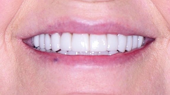 Veneers Before & After
