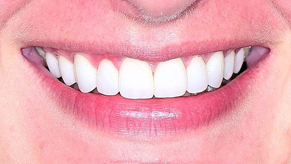 Veneers Before & After