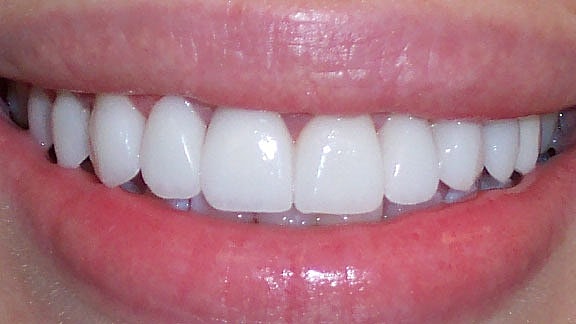 Veneers Before & After