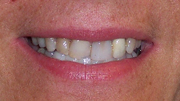 Veneers Before & After