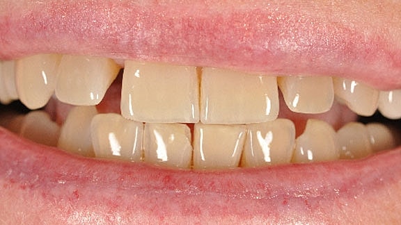 Veneers Before & After