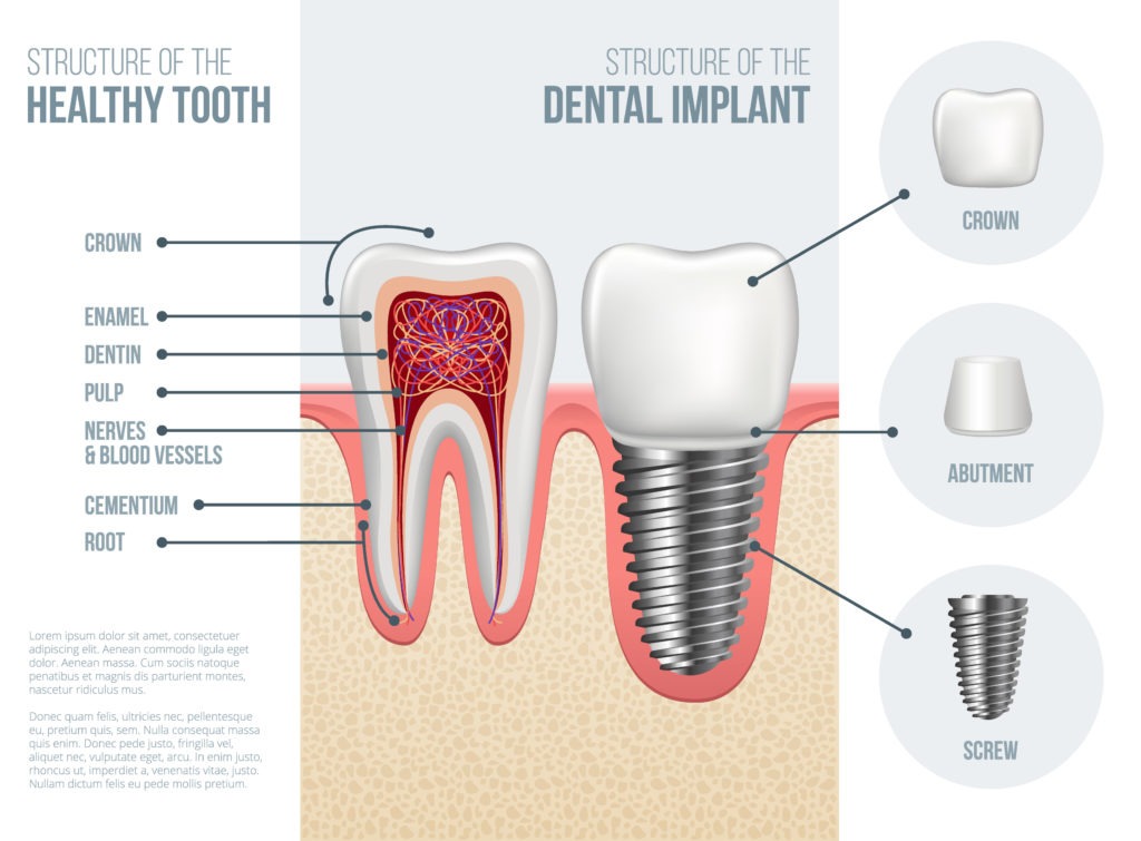 Surgical Dental Implant