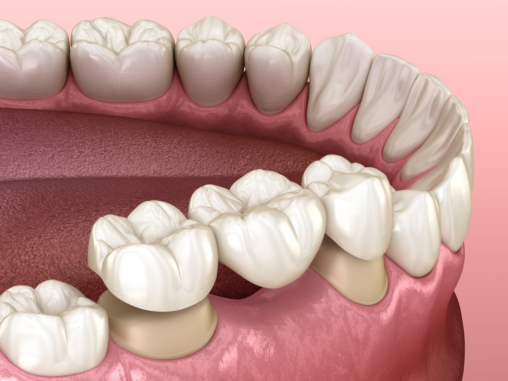 Dental Crowns Stuart