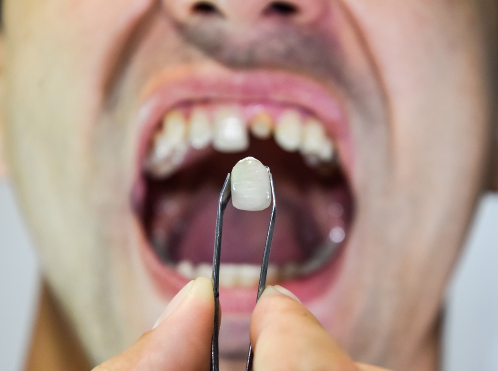 Man with Broken Tooth