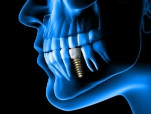 x-ray view of a dental implant